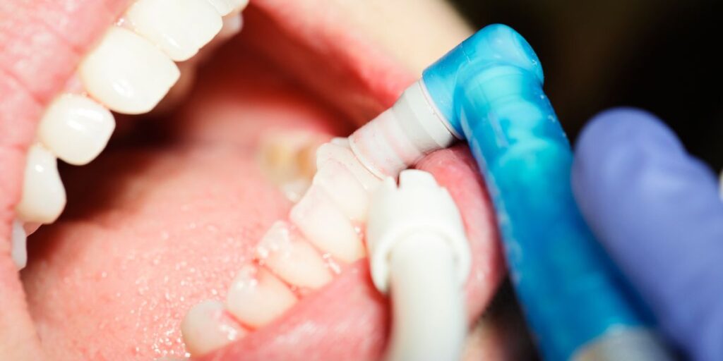 Limpieza dental importancia, Clínica dental Ceroi en Alcorcón