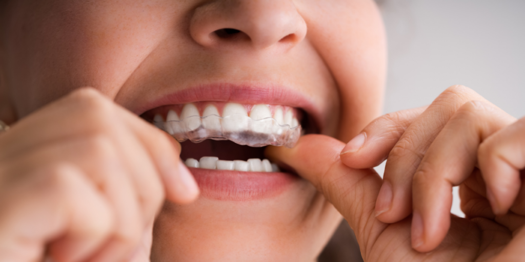 bruxismo en implantes dentales. Clínica dental Ceroi en Alcorcón